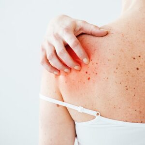 woman with allergy itch featured
